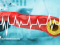 Digital drawing of plaque in arteries