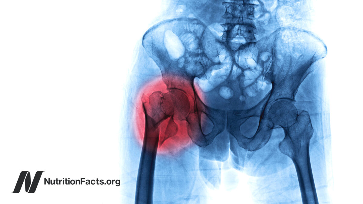 Scientific illustration of x ray with red highlight over fracture